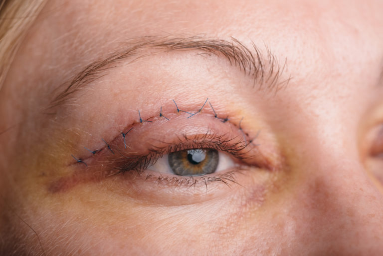 Woman with stitches in eyelid, learning about eyelid surgery recovery