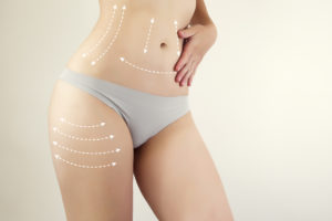 Liposuction vs. Liposculpture: What’s the Difference? Stock Photo