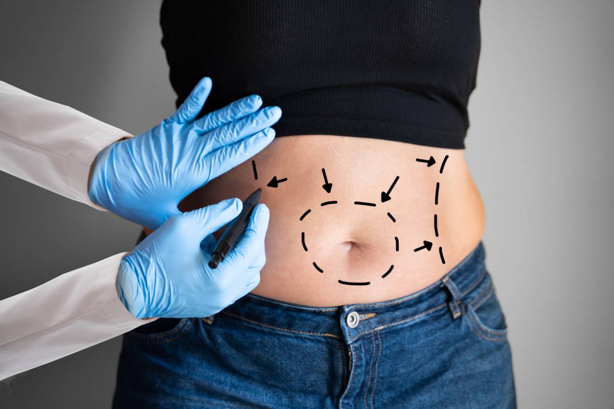 concept of tummy tuck as best procedure for your 40s