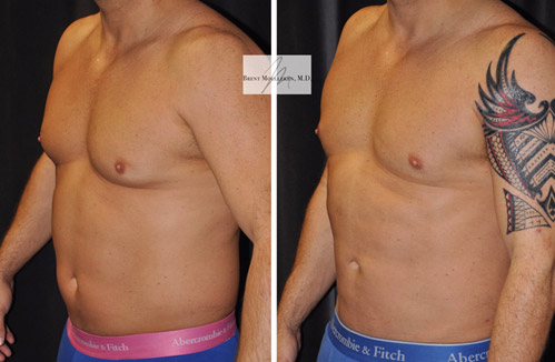 Liposuction to Abdomen, Flanks, Chest and Lateral Chest