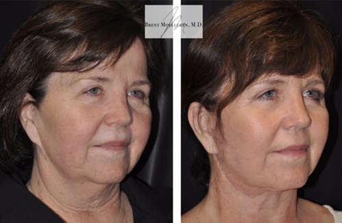 before after non surgical facelift procedure patient 2