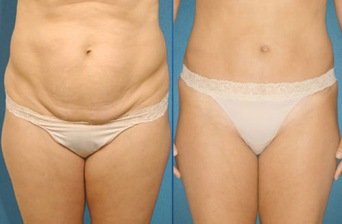 before after tummy tuck procedure patient 2
