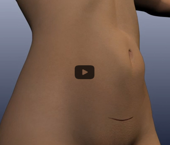 Digital representation of the signature Hybrid Tummy Tuck