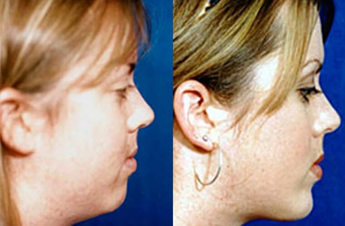before after buccal fat removal procedure patient 1