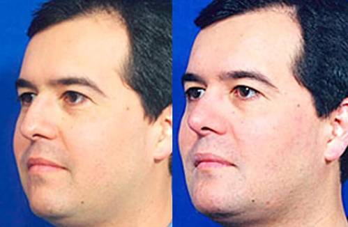 before after buccal fat removal procedure patient 2