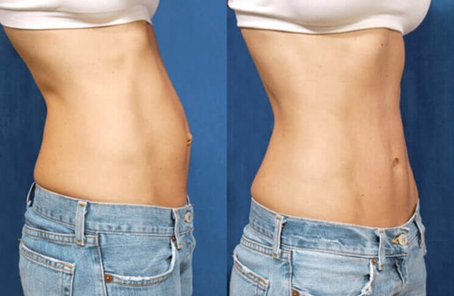 before after hybrid tummy tuck procedure patient 1