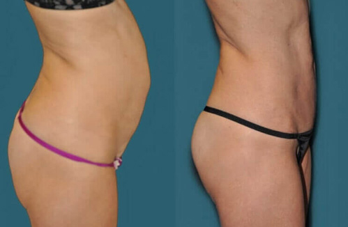 before after hybrid tummy tuck procedure patient 2