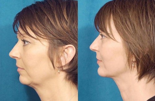before after neck lift procedure patient 1