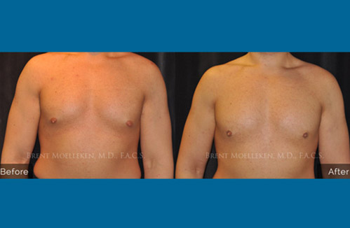 Gynecomastia procedure - Before and after picture of a patient front view