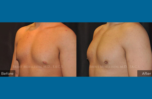 Gynecomastia procedure - Before and after picture of a patient side view