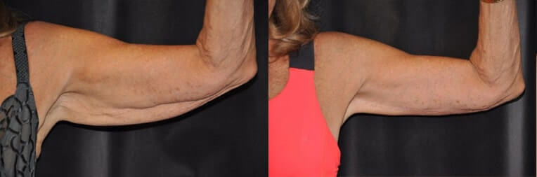 Brachioplasty (arm reduction surgery) to remove excess tissue.