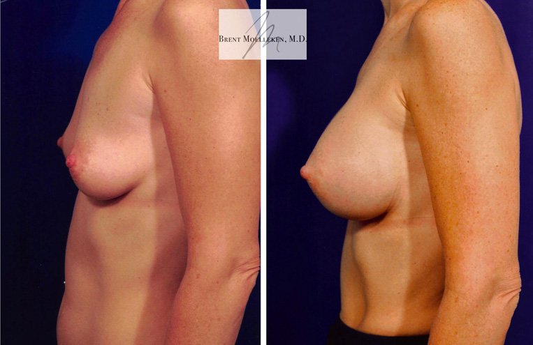 Breast Augmentation with 330 cc Saline Implants