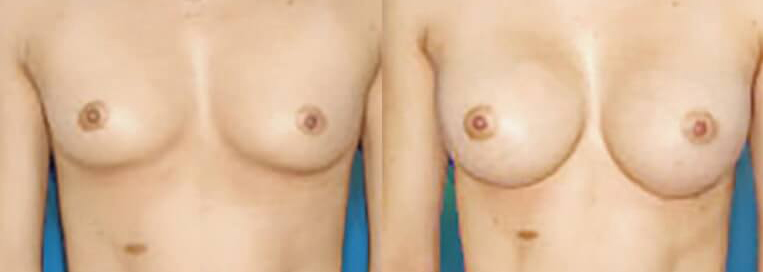 Before and after Breast Augmentation with 390 cc Smooth Saline-Implants inflated to 400cc (Inframammary Incision).