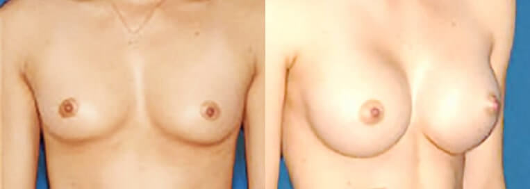 Before and after Breast Augmentation with 390 cc Smooth Saline-Implants inflated to 400cc (Inframammary Incision).