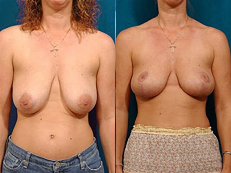 Breast lift – 3 months post-op.