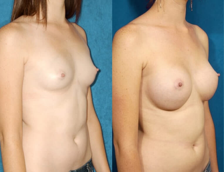 Breast augmentation with smooth saline implants, size 390cc, inflated to 400cc – inframammary incision.