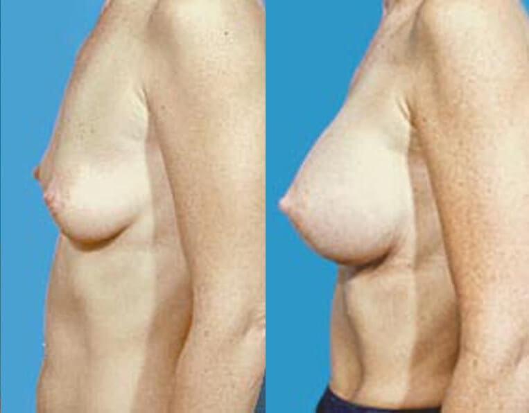 Breast augmentation with smooth saline implants, size 330cc.