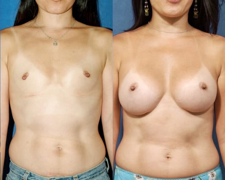 Breast augmentation with smooth saline implants, size 360cc, inflated to 375cc submuscular placement/inframammary incision.