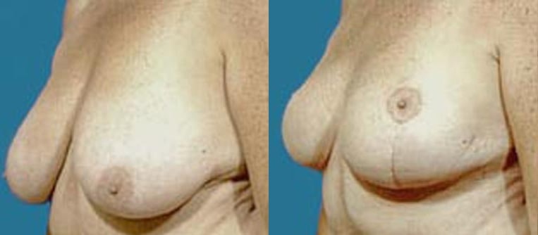 Breast reduction with lift.