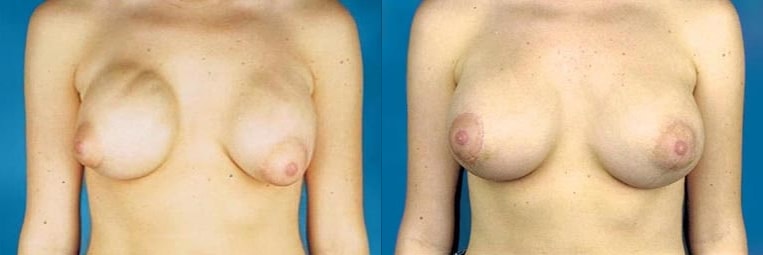 Revision to implant placed above the muscle and nipple asymmetry.