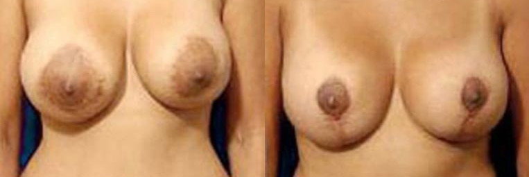 Conversion Benilli to Wise pattern lift, removal of 475cc saline implants and replaced with silicone implants, size 360cc right, 240cc left – 3 months post-op.