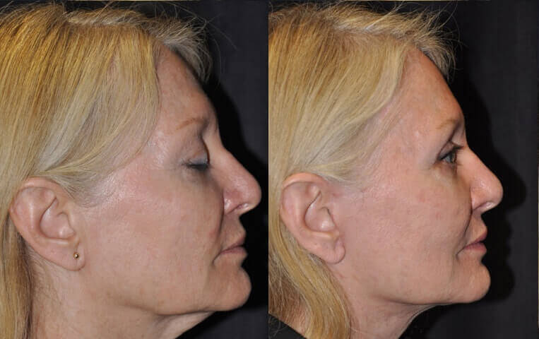 Facelift with Necklace © and upper blepharoplasty.