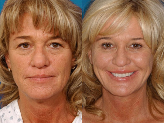 Facelift with Neck-lace procedure, Livefill to lips, superficial cheeklift with Livefill grafts to lower eyelids, upper blepharoplasty, Co2 laser resurfacing.