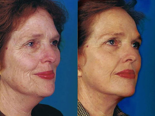 CO2 laser resurfacing, face and neck-lift with superficial cheeklift.
