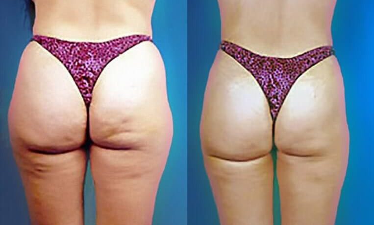 Liposuction to abdomen, waist, flanks, inner/outer thighs and knees.