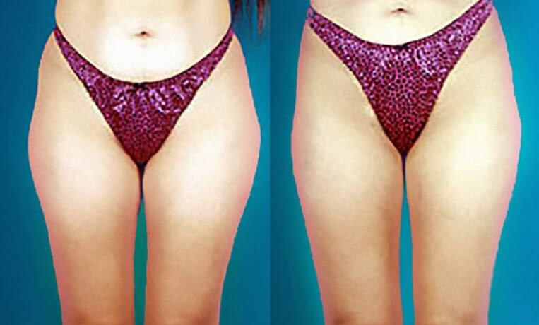 Liposuction to abdomen, waist, flanks, inner/outer thighs and knees.