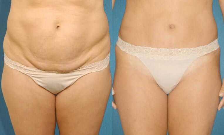 Abdominoplasty tummy tuck with liposculpture of abs and flanks.