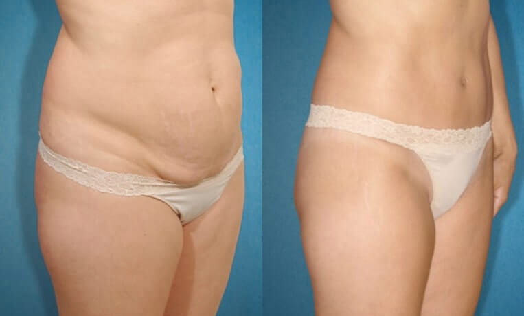 Abdominoplasty tummy tuck with liposculpture of abs and flanks.