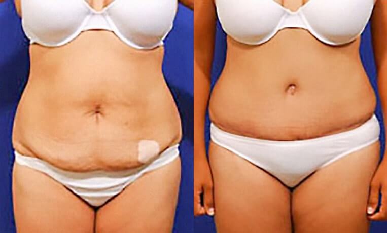 Full abdominoplasty with liposuction and liposculpture.