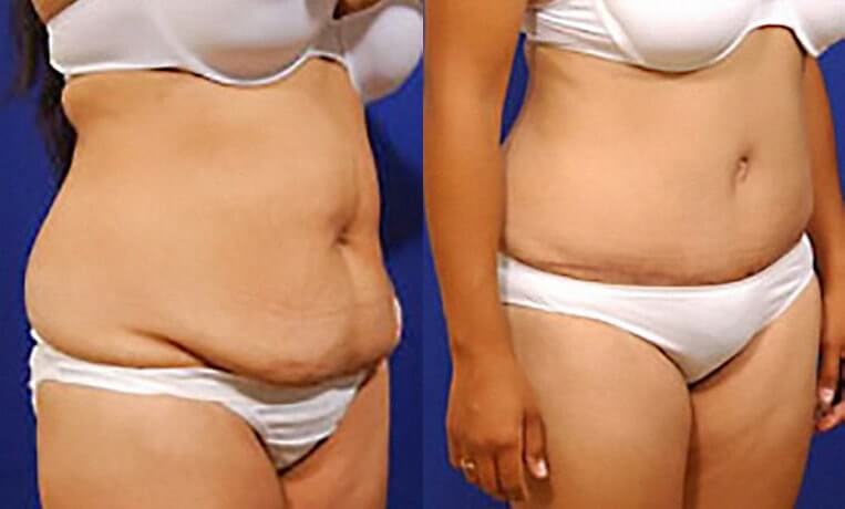 Full abdominoplasty with liposuction and liposculpture.