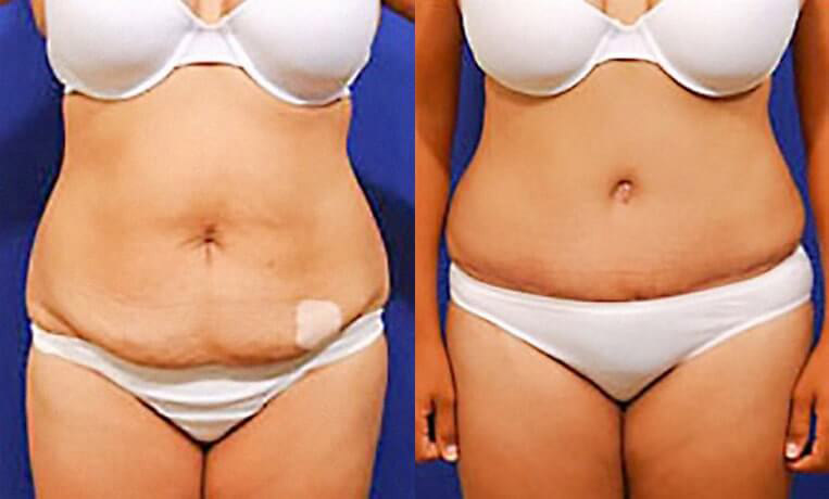 Full abdominoplasty with liposuction and liposculpture