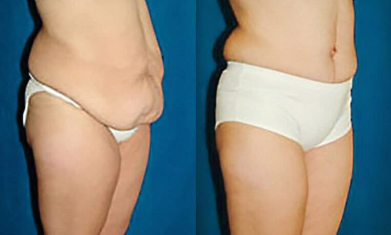 Abdominoplasty with flank extention, thighlift and liposuction