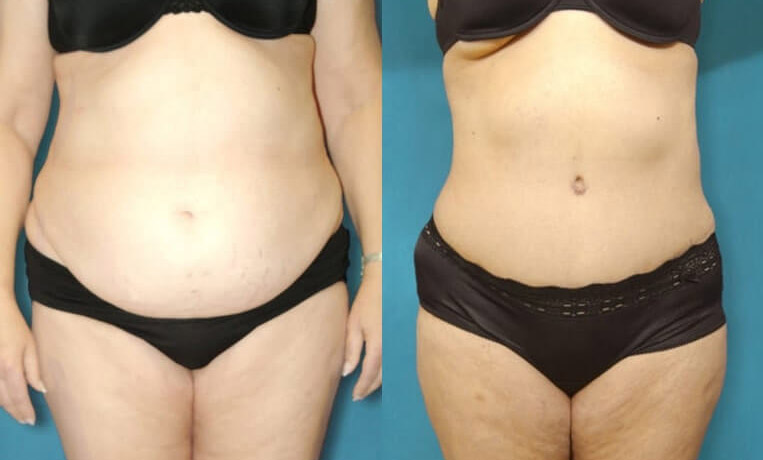 Tummy Tuck with Flank Extension, Liposuction to Abdomen and Flanks