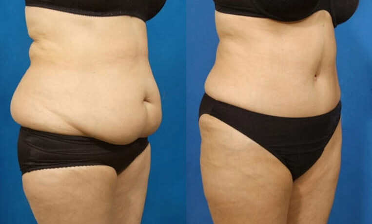 Full abdominoplasty with liposuction to flanks, abs, and waist.