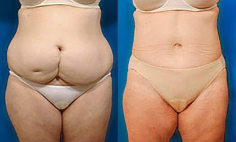 Abdominoplasty with flank extension, liposuction of waist and abodomen.