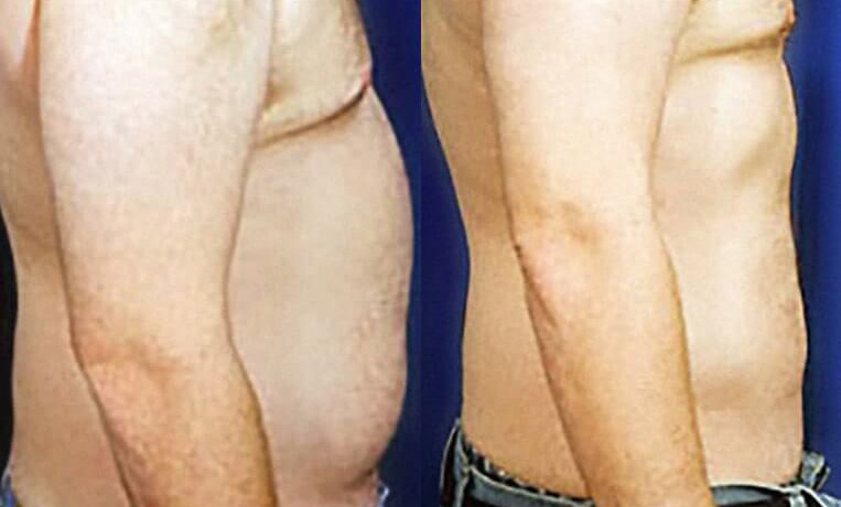 Liposuction of the abdomen