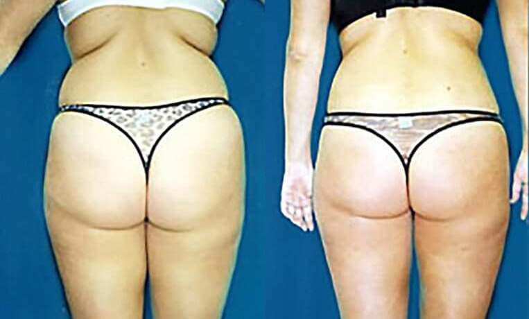 Liposuction to abdomen, waist, flanks, inner/outer thighs.