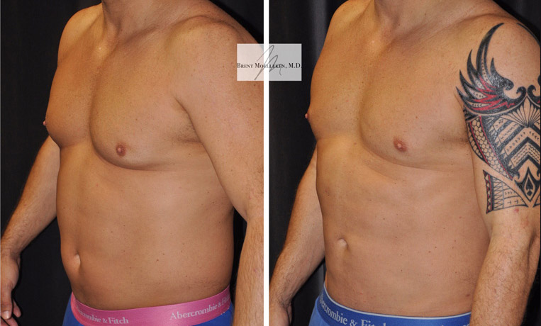 Liposuction to Abdomen, Flanks, Chest and Lateral Chest