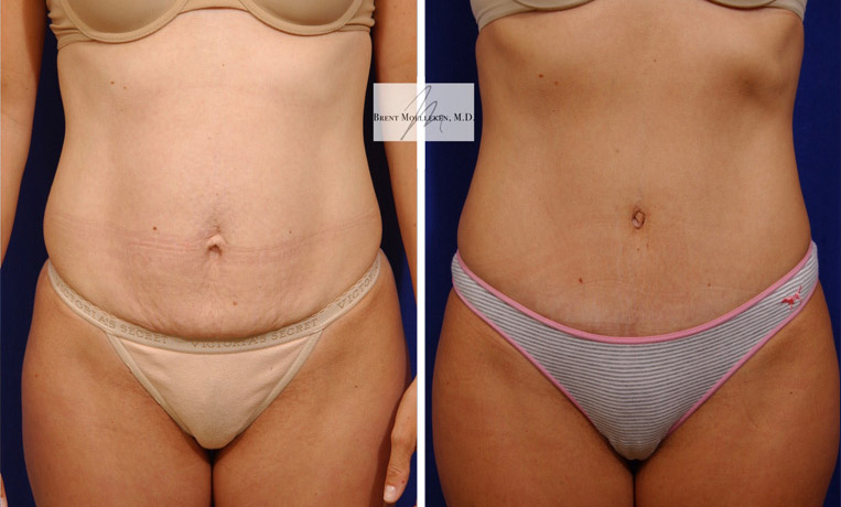 Tummy Tuck with Vertical Incision, Diastasis Repair, Liposuction to Abdomen