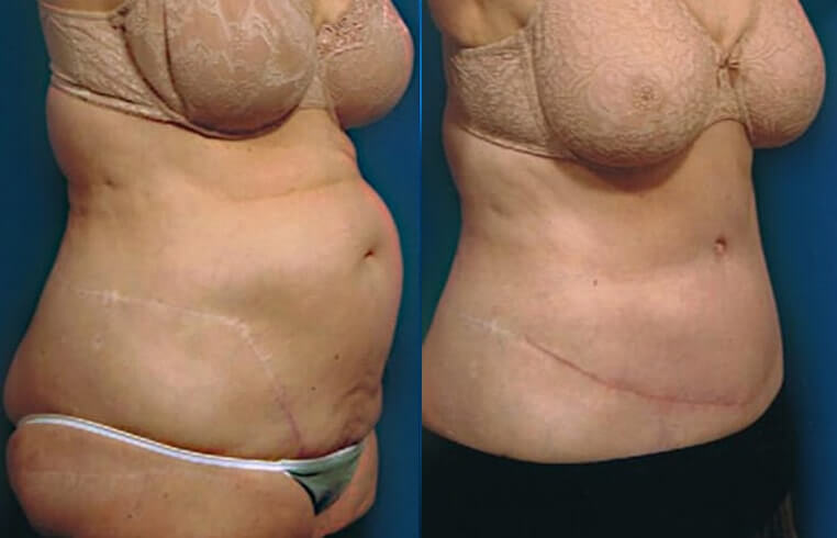 Abdominoplasty revision with liposculpture of waist and flanks. After photo is 2 months post-op.