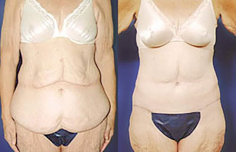 Abdominoplasty and bilateral flank panniculectomy.