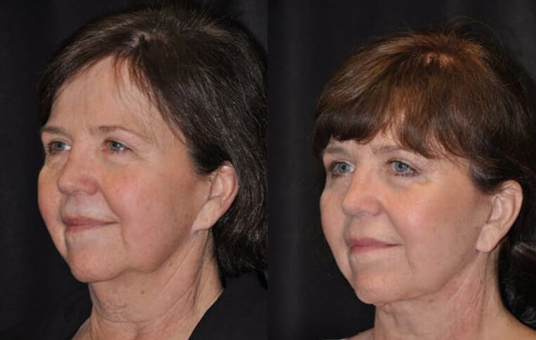 Facelift with Necklace, Earlobe Revision, Livefill to Lips, USIC Cheeklift, Upper Blepharoplasty