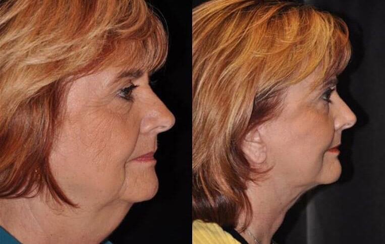 Facelift with Necklace and Upper Blepharoplasty