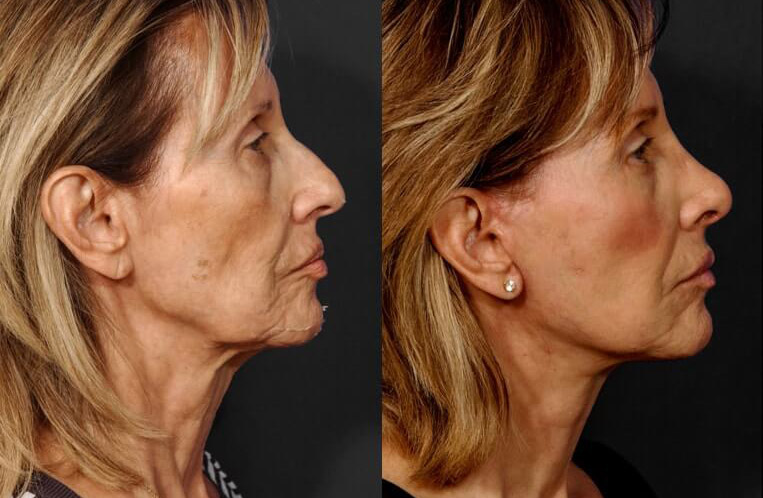 Face and neck-lift with neck-Lace procedure, superficial cheeklift with canthopexy, lower blepharoplasty, Livefill to naso labial folds, marionette, upper-lower lips, brows, DAO muscle release, rhinoplasty with tip plasty, lateral osteotomy, and dorsal reduction.