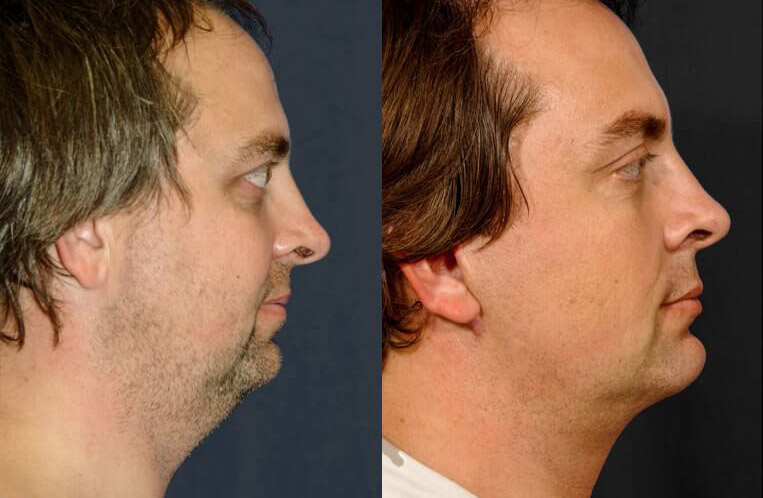 Face and necklift, cheeklift with canthopexy and lateral canthal elevation, LiveFill to nasiolabial folds and marionette lines, buccal fat pad excision, upper blepharoplasty, minimally invasive browlift and rhinoplasty.