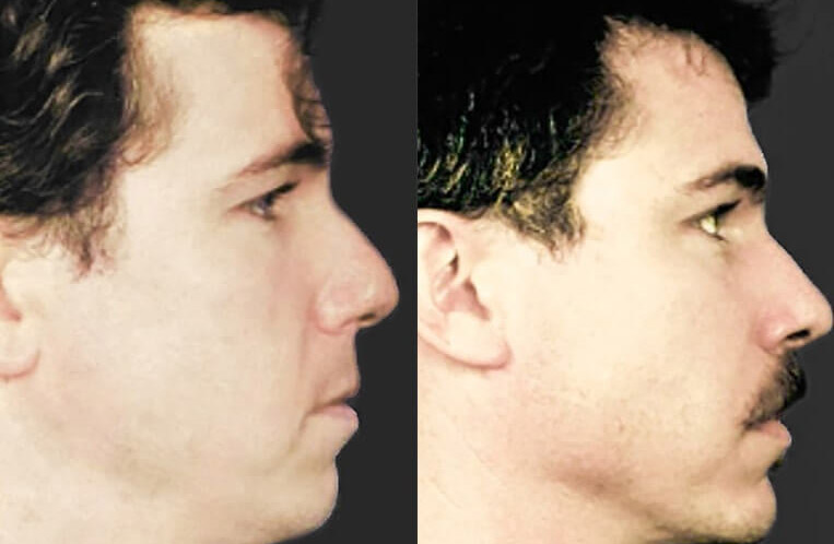 Chin implant, buccal fat pad removal, nasal tip rhinoplasty